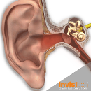 Acufeni